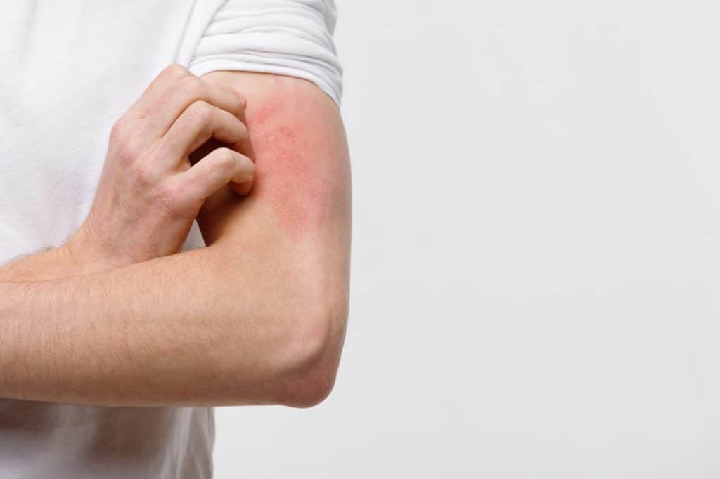 Eczema, medically referred to as atopic dermatitis, is a chronic inflammatory skin condition that presents with symptoms such as dryness, itching, redness, and scaly patches on the skin.
