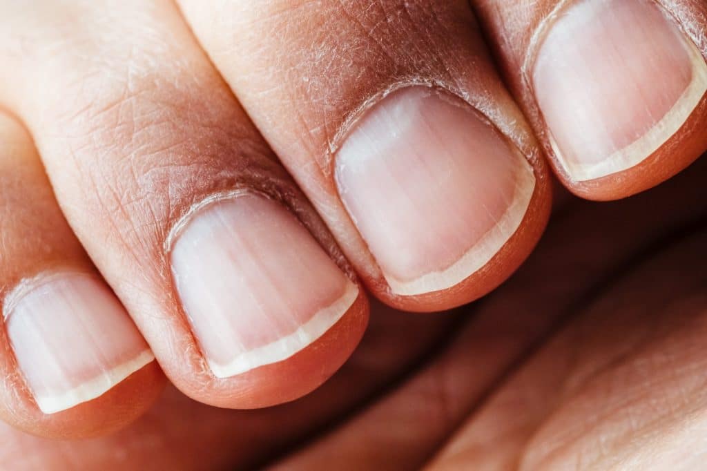 Onychomycosis, or fungus infections of the nails, is quite prevalent. Both the nails on the fingers and toes are affected. 