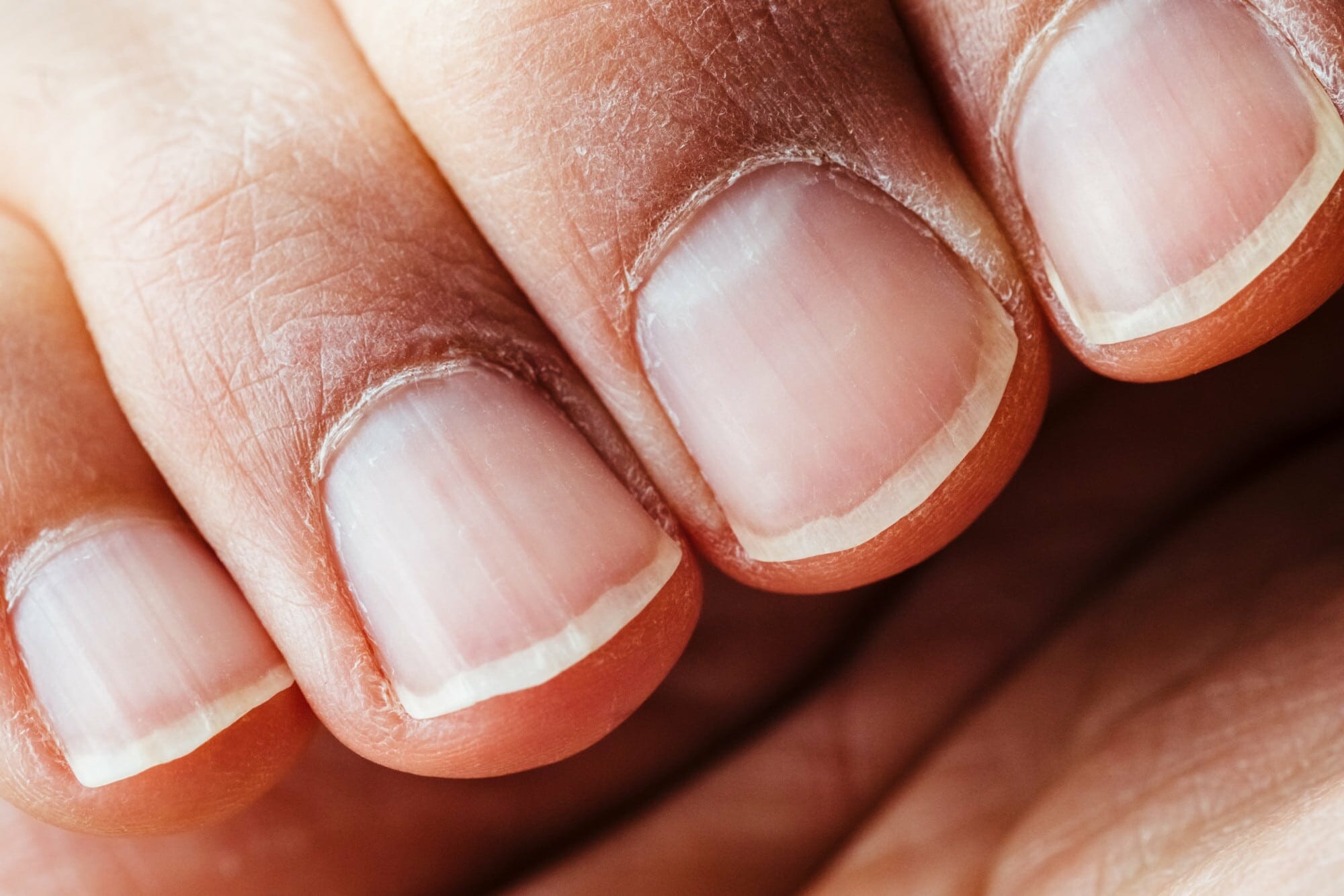 Fungal nail infections : A General Overview