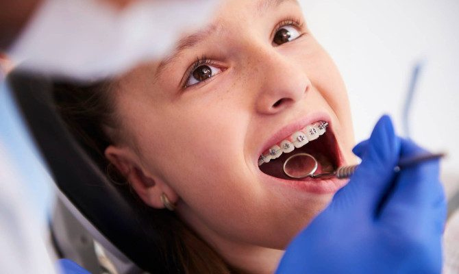 Dental braces : Types, significance, and care