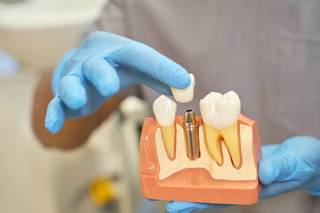 A standard dental treatment option for restoring one or more lost teeth is a dental bridge.
