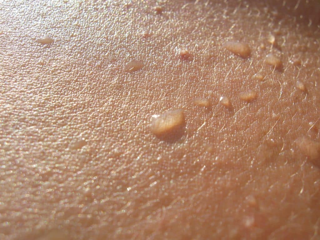 Bullae are fluid-filled sacs that develop inside or beneath the epidermis or mucous membranes