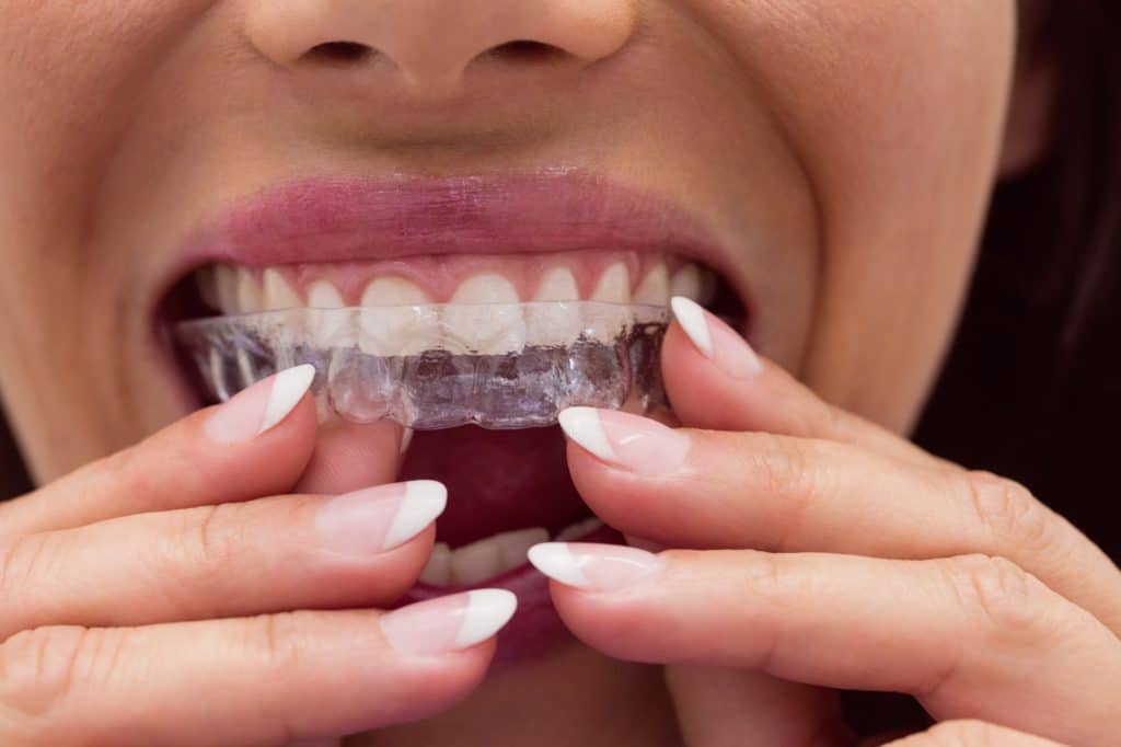Invisalign is a form of orthodontic treatment that progressively realigns teeth using transparent plastic trays. 