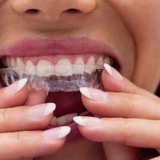 Invisalign aligners : What do I need to know?