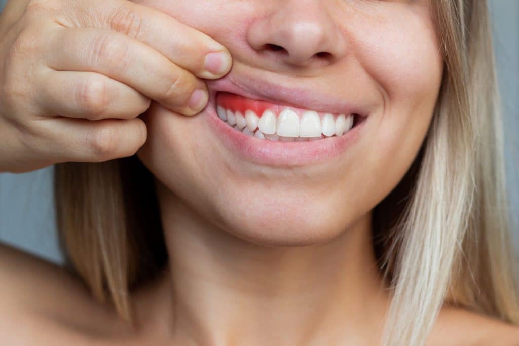 Healthy gums are crucial to preserving optimum wellness because they not only stop tooth decay and gum issues but also lessen the risk of the development of any infection inside the body.