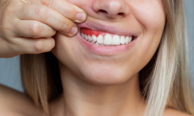 All about Gums Health