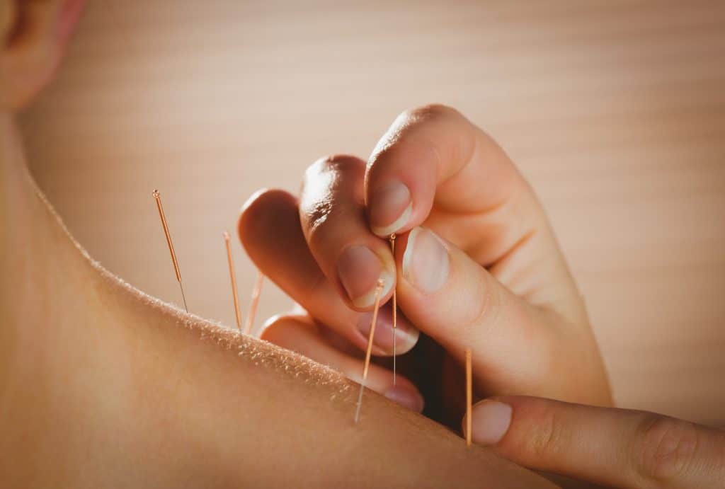 Acupuncture is an alternative treatment and an element of age-old Chinese medical practices in which fine needles are placed into the skin. 