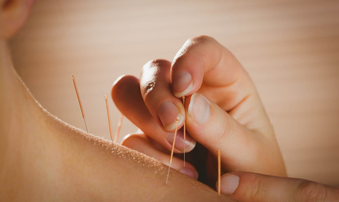 Acupuncture : What do I need to Know?