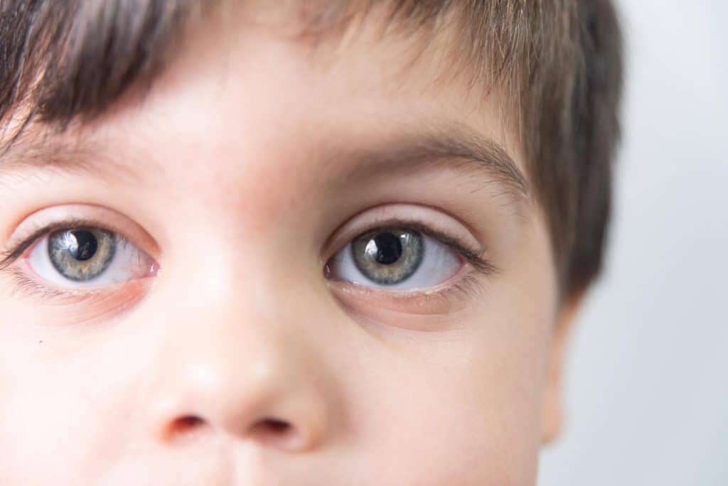 Amblyopia, also called lazy eye, is a vision condition affecting children and adults worldwide. Despite the absence of any significant anatomical defects or eye diseases, it is characterized by limited or impaired vision in one eye.