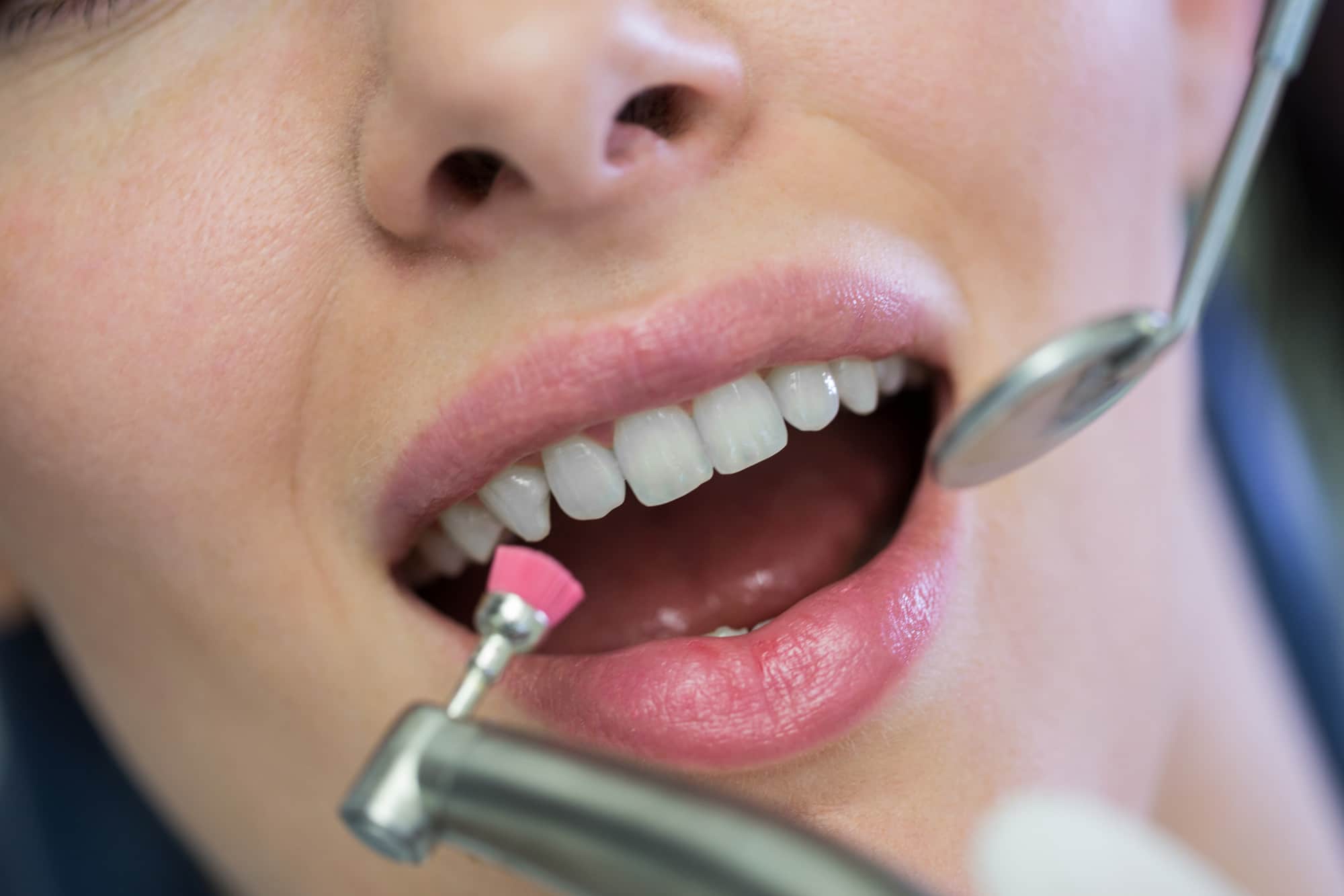 Dental Abrasion: Symptoms, Causes, and Treatment
