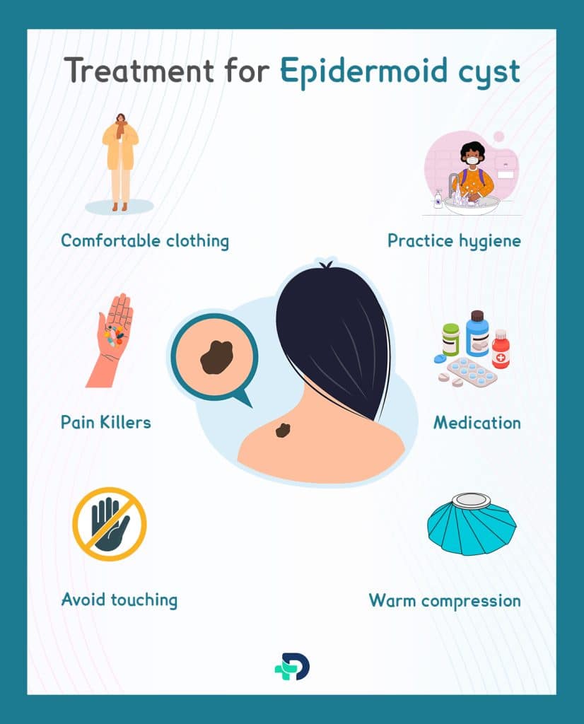 Treatment for Epidermoid Cyst.