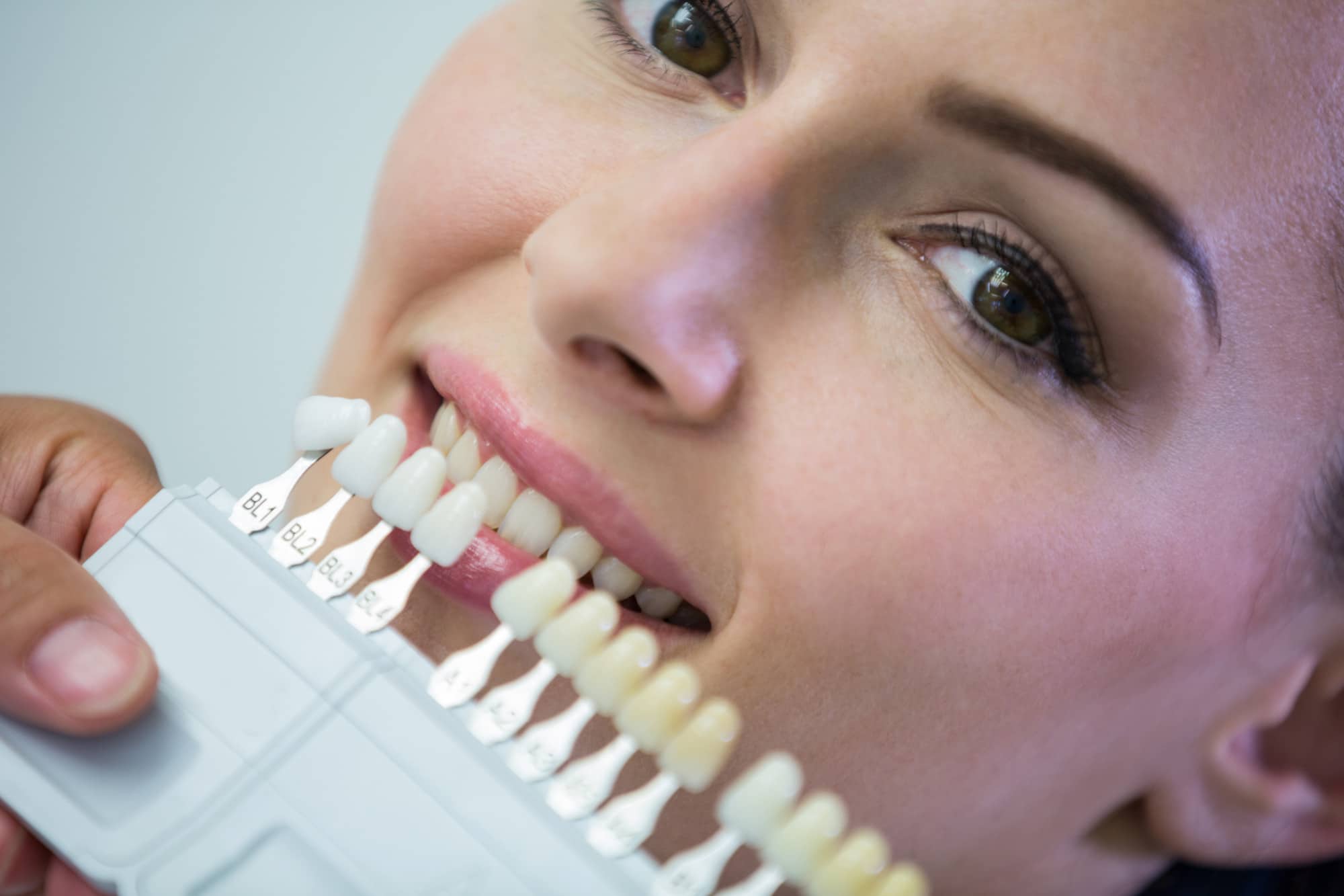 A Complete Guide to Transforming your Smile with Dental Veneers