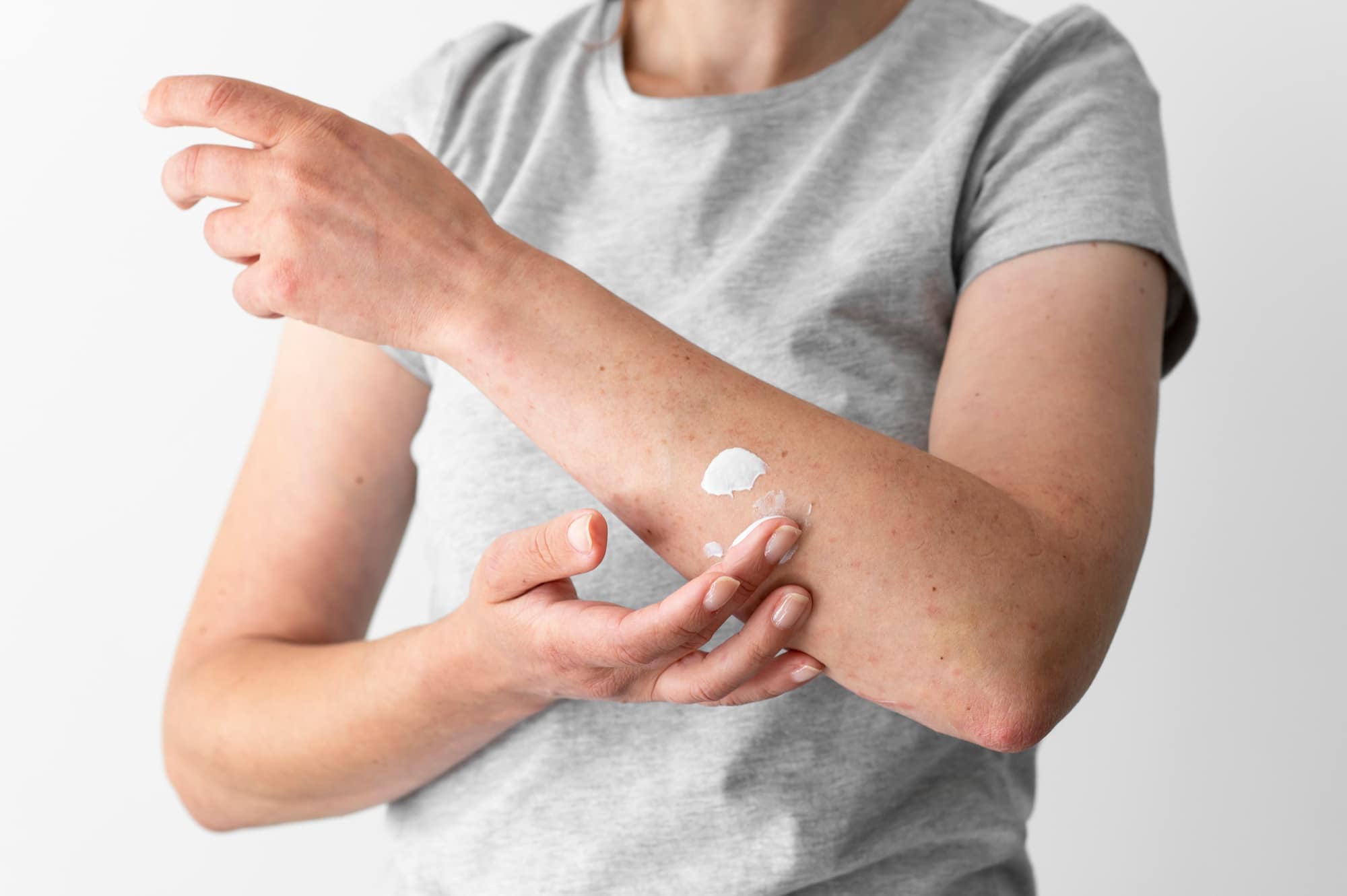 Ringworm Infections: Understanding Symptoms, Types, Treatment and Prognosis