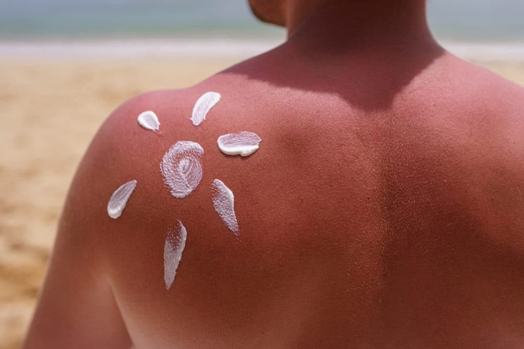 Sunburn is the skin damage caused by the sun's ultraviolet radiation or other artificial sources viz; tanning bed and sunlamps. Sunburn varies from mild to severe. In severe cases, the skin appears red, warm to the touch, and sometimes exhibits painful blisters.