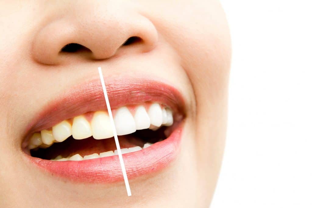 A cosmetic dental technique, teeth whitening, is done to whiten teeth and remove stains or discoloration. It is done to make the smile more beautiful and brighter.