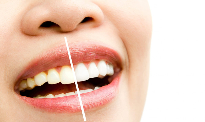 Understanding Teeth Whitening: Process, Alternatives and Side effects