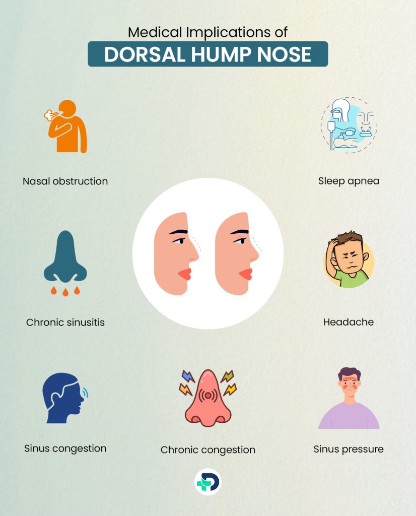 Medical Implications of Dorsal Hump Nose.