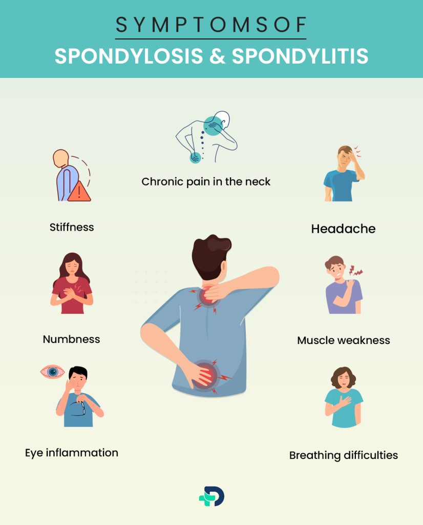 Symptoms of Spondylosis & Spondlitis.