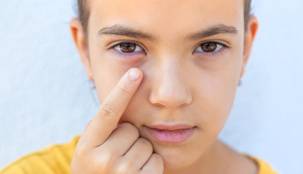 Being subjected to a bug bite or sting is an undesirable encounter for individuals, regardless of the specific location on the body where it transpires. However, a sting or bite occurring in close proximity to the eye can occasionally elicit greater anxiety.