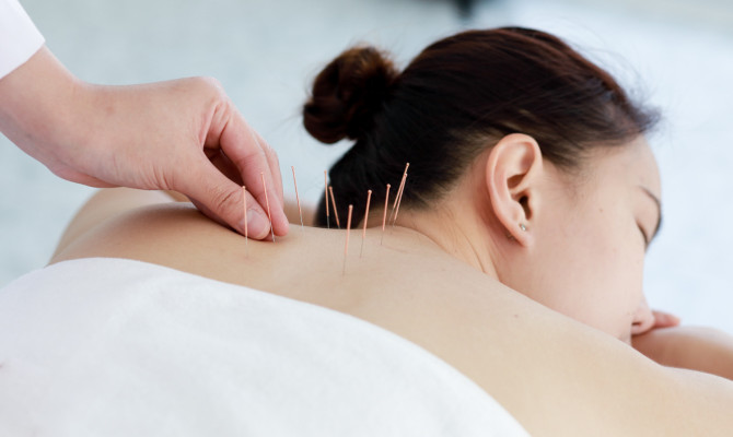 Acupuncture vs Dry Needling | What Are  The Benefits Of Each?