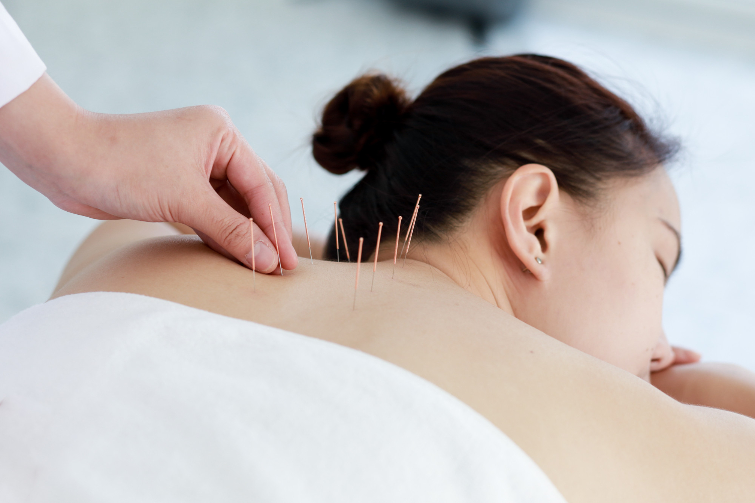 Acupuncture vs Dry Needling | What Are  The Benefits Of Each?