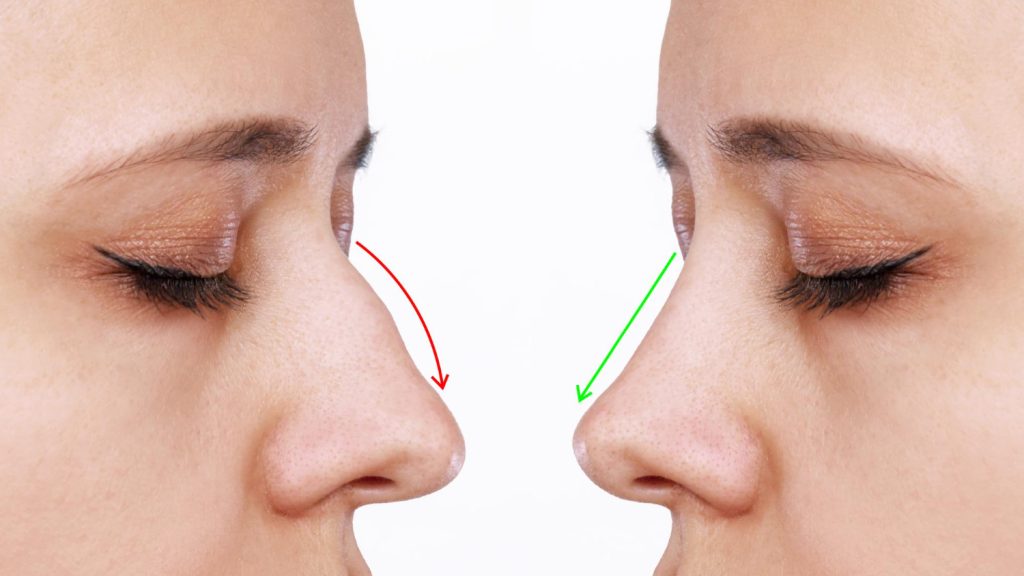 A dorsal hump nose, often referred to simply as a dorsal hump, is a nasal feature characterized by a visible and raised bump or curvature along the bridge of the nose. This can vary in size and shape and is typically made of bone and cartilage. 