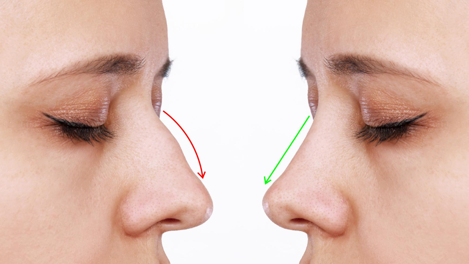 Everything You Need To Know About Dorsal Hump Nose