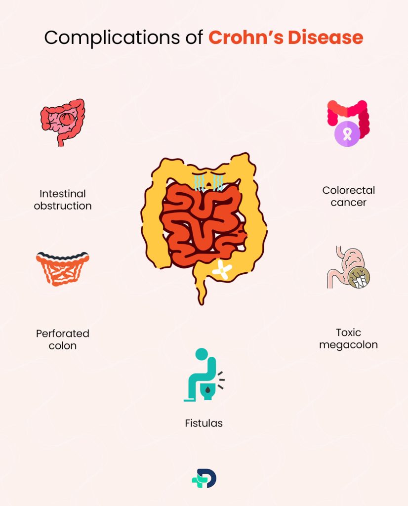 Complications of Crohn's Disease.