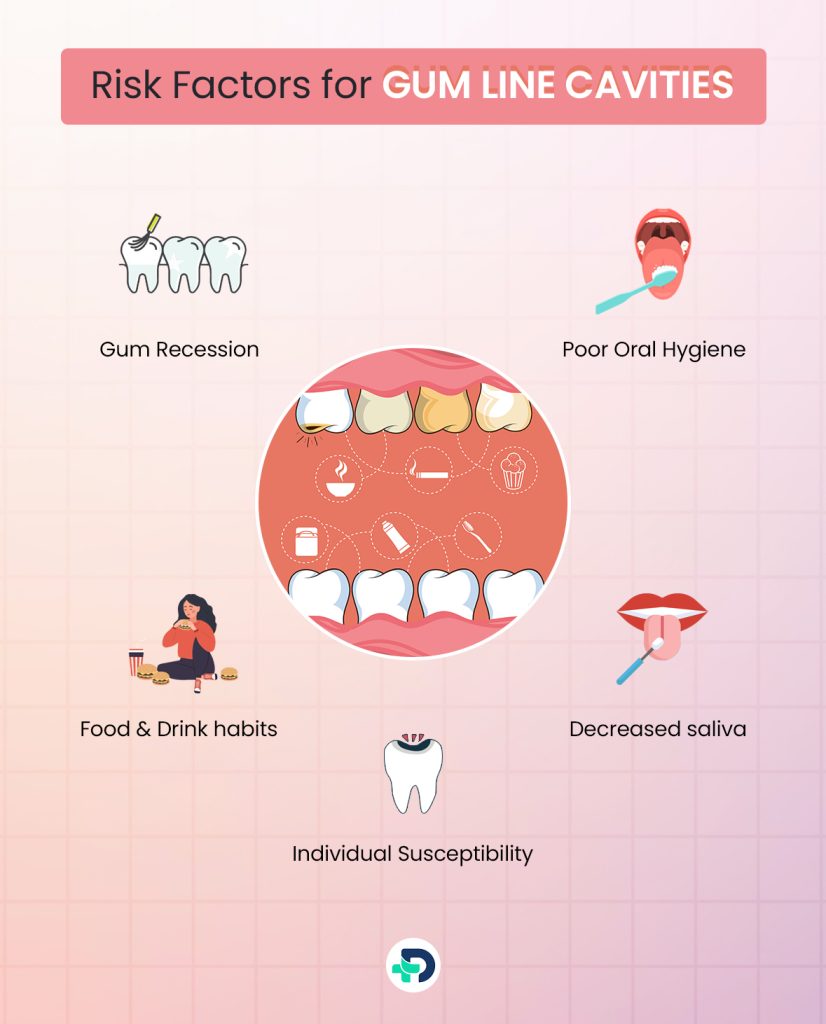 Risk factors for Gum Line Cavities.