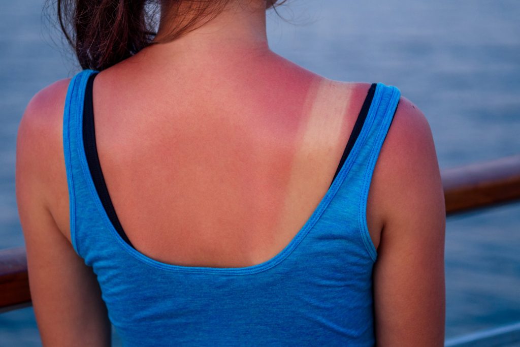 Tanning Bed Rash also known as photosensitivity dermatitis or simply tanning rash. It is a skin condition characterized by redness, itching, and sometimes blistering or hives that develop shortly after exposure to UV radiation from tanning beds or Sun lamps.