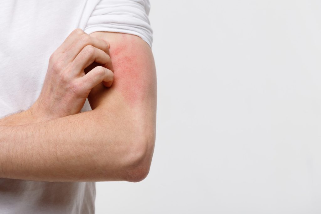 Bruises, those unsightly patches of skin discoloration that often result from bumps, falls, or injuries, are usually associated with pain and tenderness. However, what surprises many people is the maddening itch that sometimes accompanies these published blue marks. 