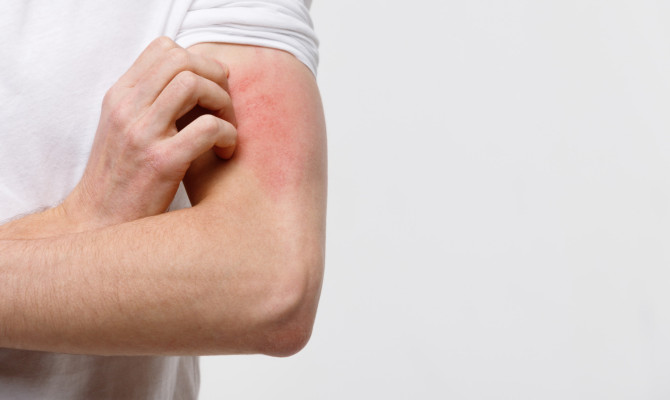Scratching The Surface: Understanding  Why Bruises Itch
