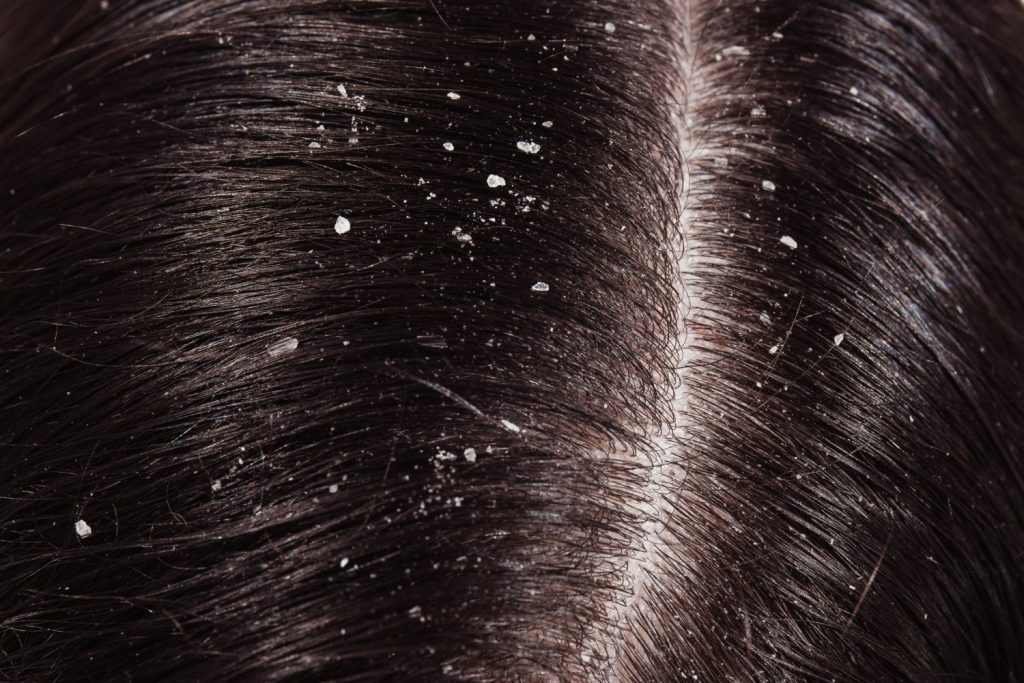 Dandruff, pesky white flakes that can land on your shoulders and make you feel self-conscious, is a common scalp condition affecting millions worldwide. 