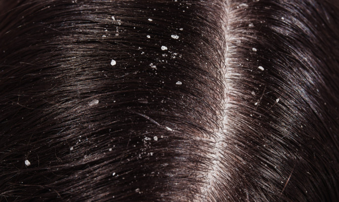 Is Dandruff Contagious?  Myths & Facts  About Dandruff