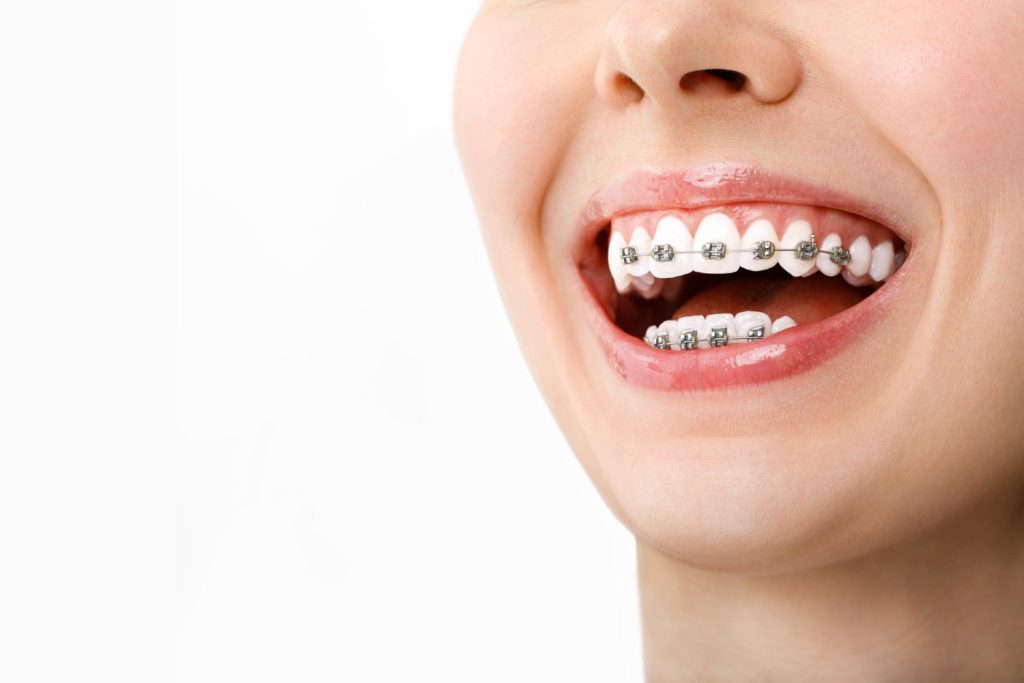 Self-ligating braces are a form of orthodontic therapy used to straighten teeth in a manner similar to traditional metal braces. The brackets used in the therapy include a special door that collects and keeps the arch wire, setting them apart from conventional metal braces. 